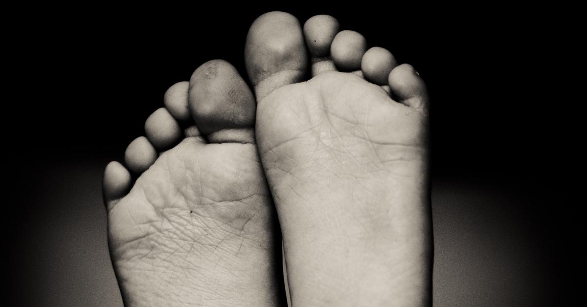  Ispucala koža izmedju prstiju na nogama i kako to da sprečite