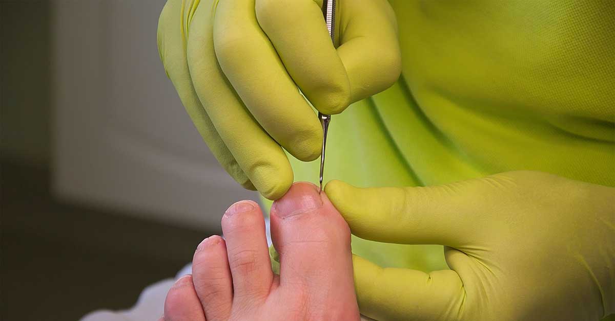  Kako izlečiti urasli nokat i saveti da do njega i ne dođe!