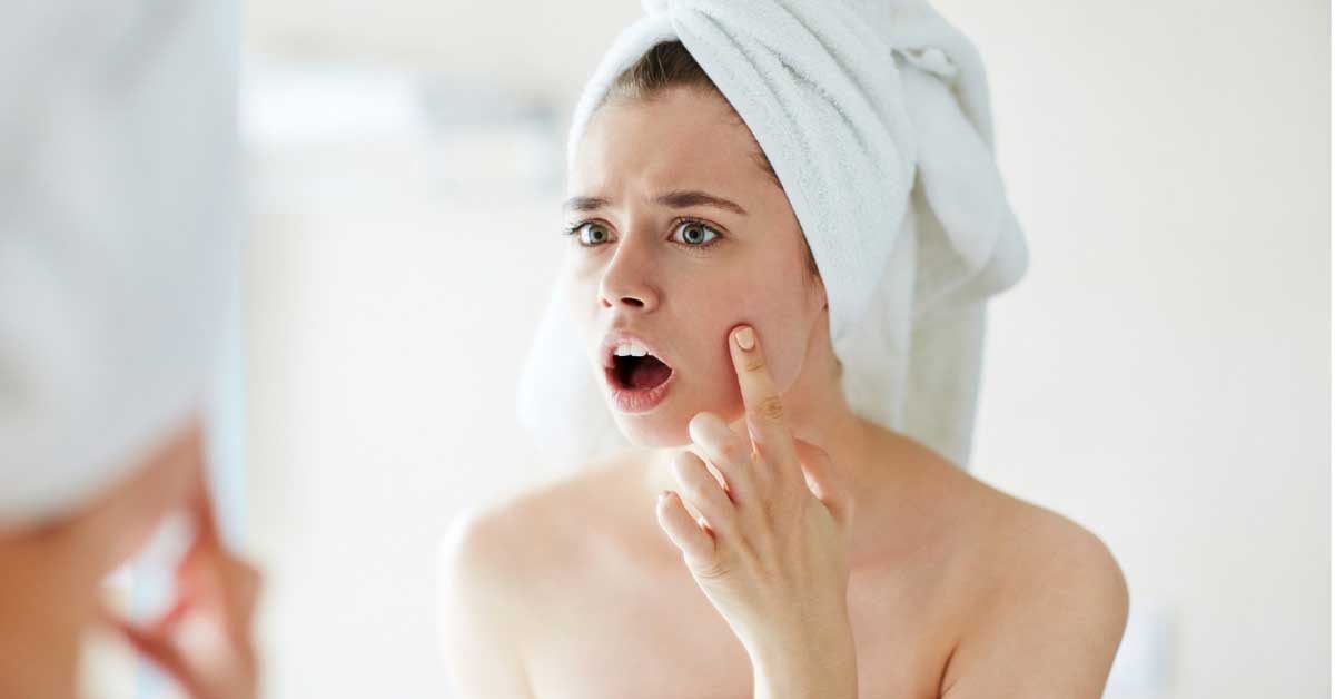  Problem sa aknama je sve češći, a evo šta je zapravo pravo rešenje!
