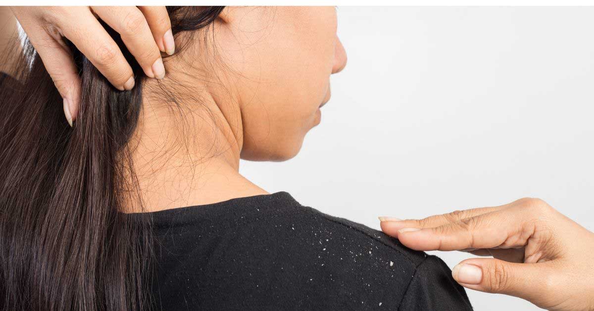  Šta je perut u kosi? Uzroci, vrste i simptomi