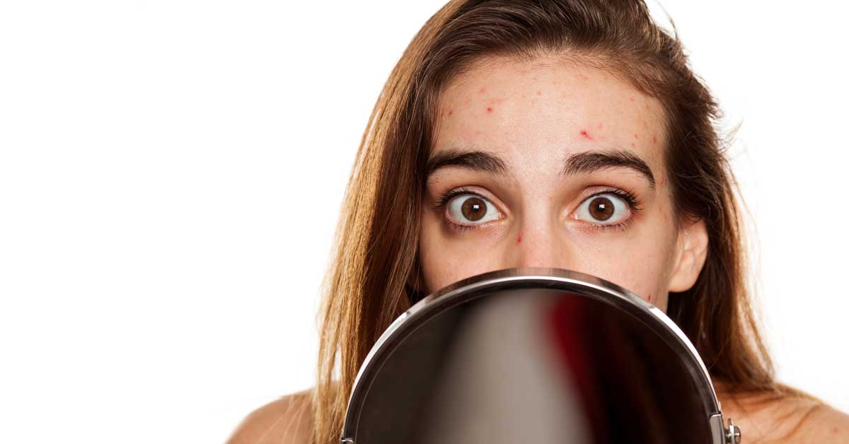  Fungalne akne nisu obične. Prepoznajte simptome!