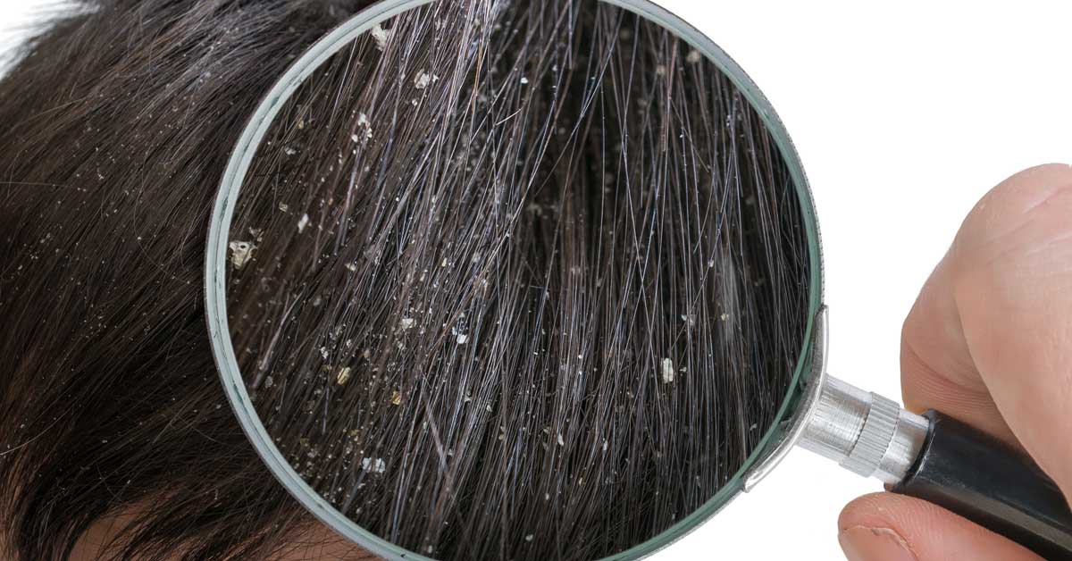  Seboroični dermatitis glave: uzroci i lečenje