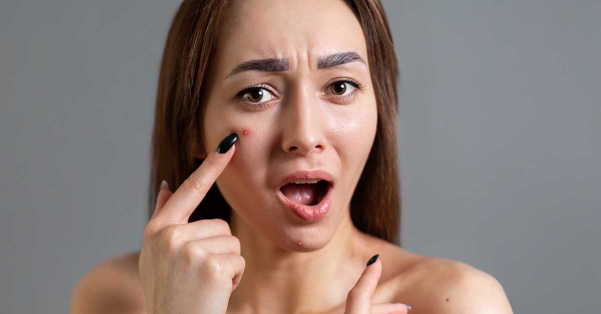  Šta su vodene bubuljice i kako da ih razlikujemo od ostalih?!