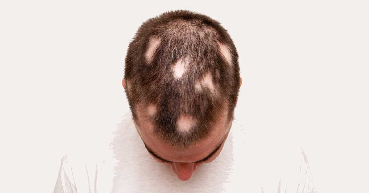  Opadanje kose u krugovima: zašto se javlja i kako ga ublažiti