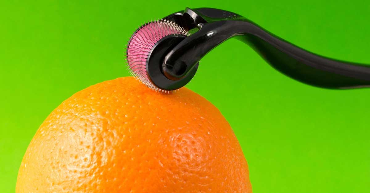 dermaroler za strije