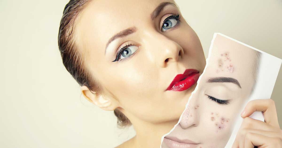  Koža sklona aknama i njena nega