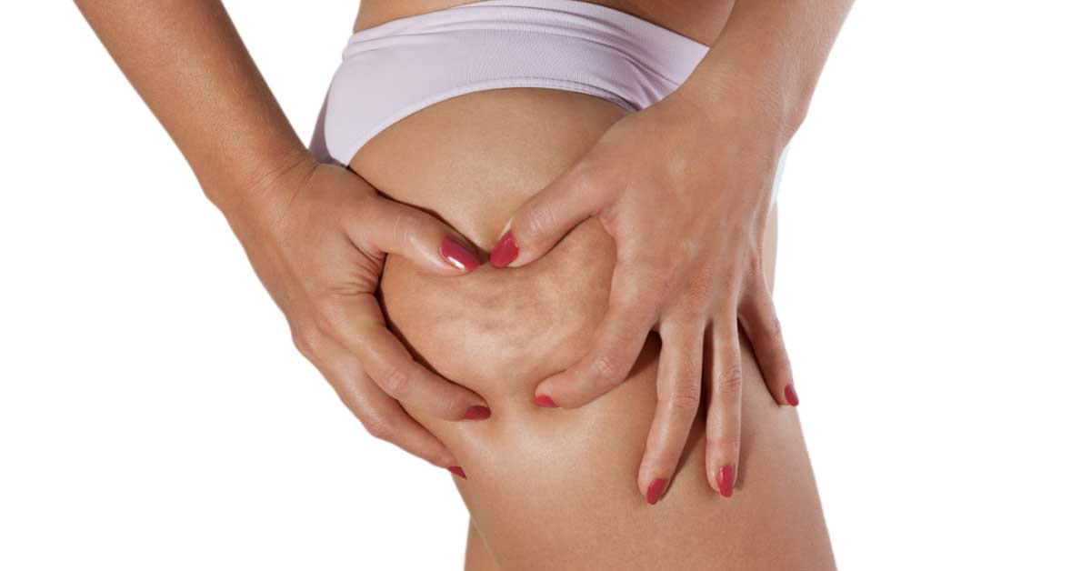  Kako ukloniti površinski celulit?