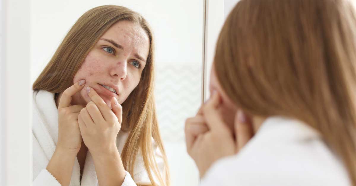  Akne kod odraslih i kako protiv njih