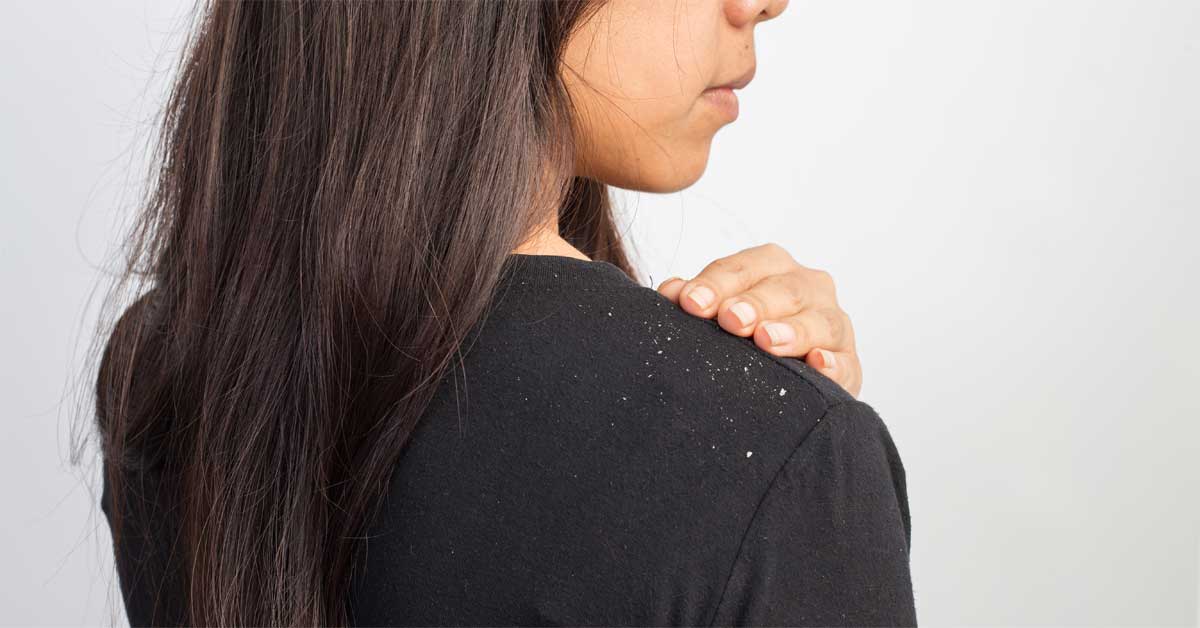  Ove maske protiv peruti su zaista čudesne!