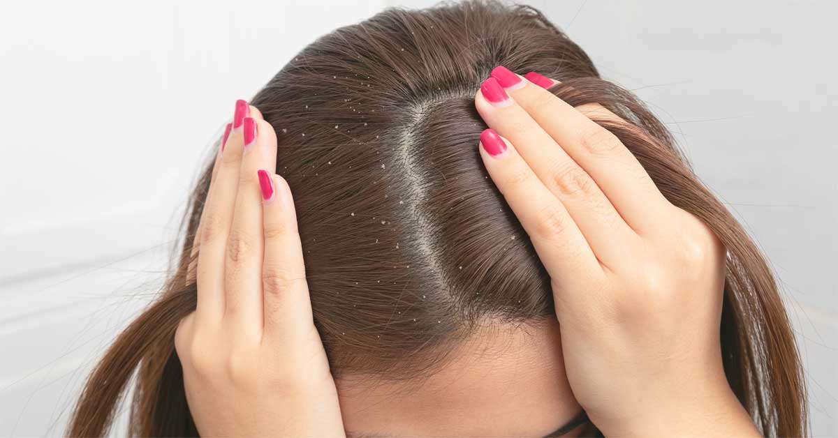  Šta je psorijaza na koži glave i kako znate da to nije perut?