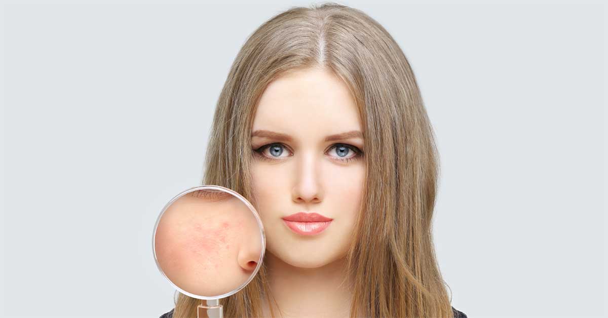  Jednostavni načini da fleke od bubuljica nestanu!