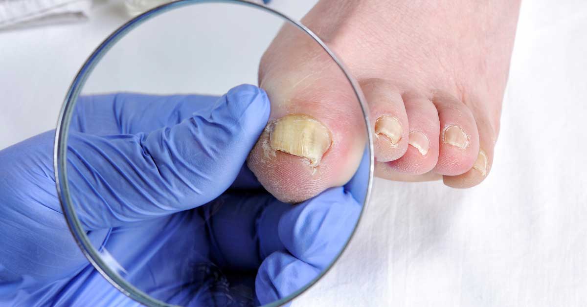 Kako se rešiti gljivica na noktima najlakše
