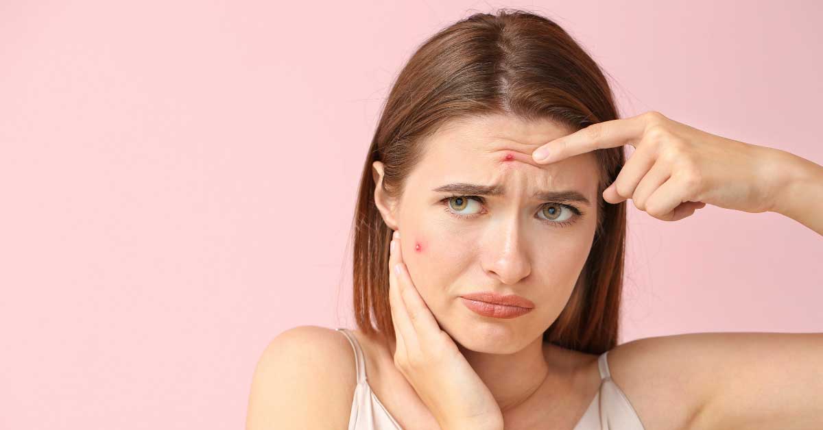  Kako smiriti upaljenu bubuljicu? Evo načina!