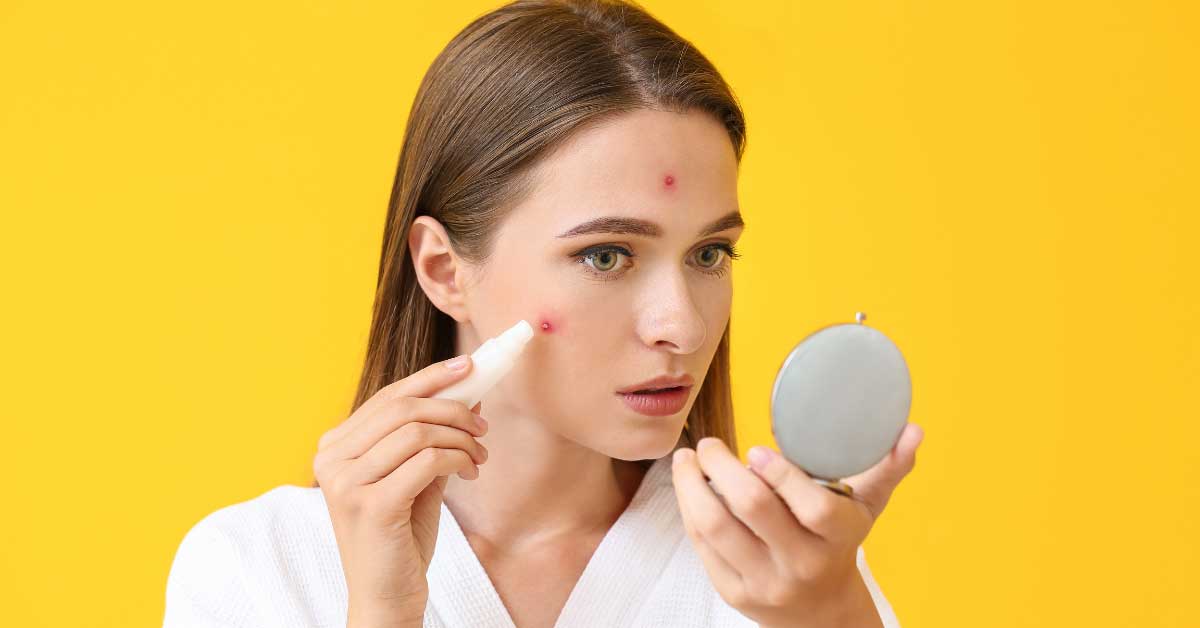  Koji je najbolji antibiotik za akne?