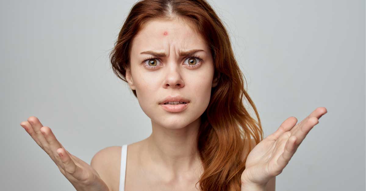  Bakterijske akne – šta je sad to?