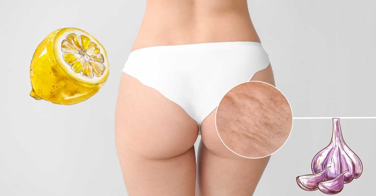  Limun i beli luk za celulit: jednostavno, a radi!