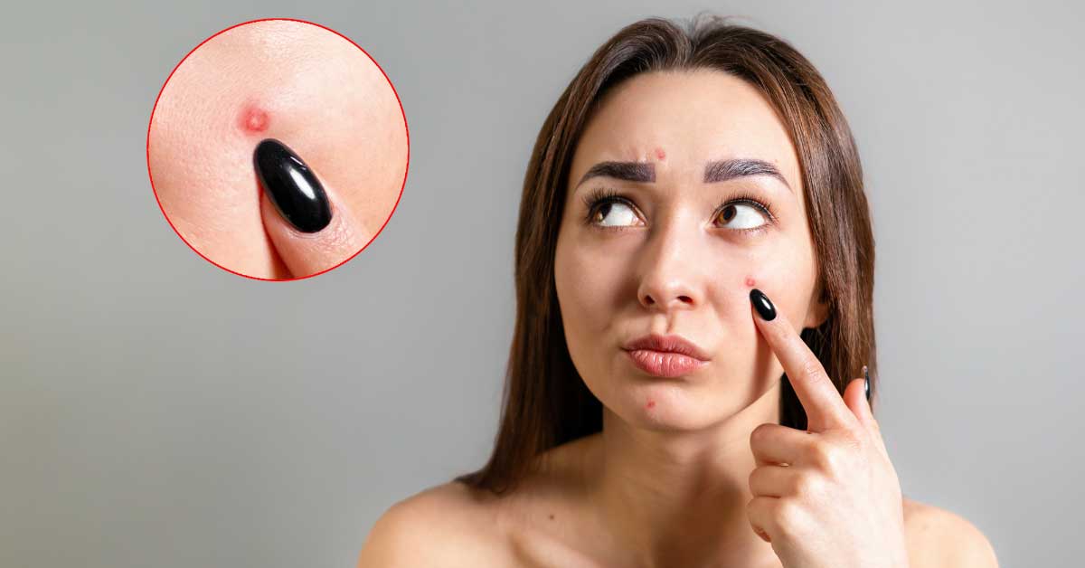  Majorka akne nisu dečija igra! Sprečite ih!