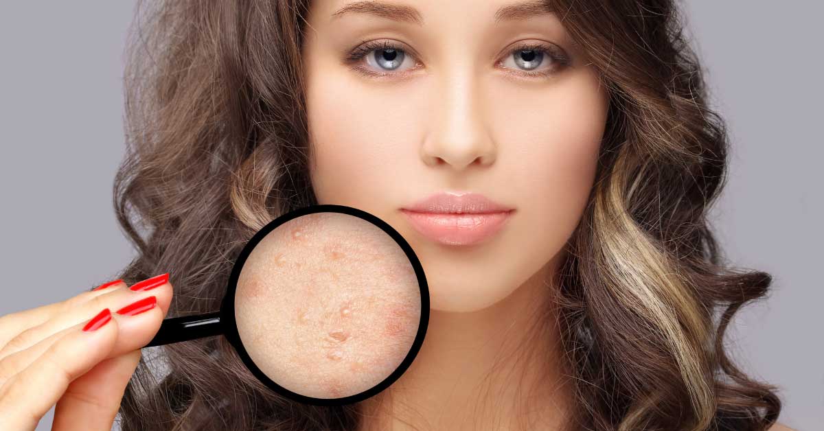  Ožiljci od akni i svi načini za njihovo uklanjanje