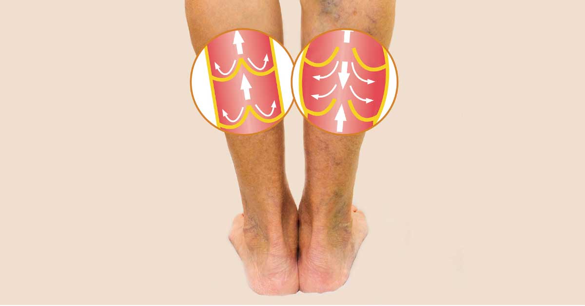 prosirene vene uzroci