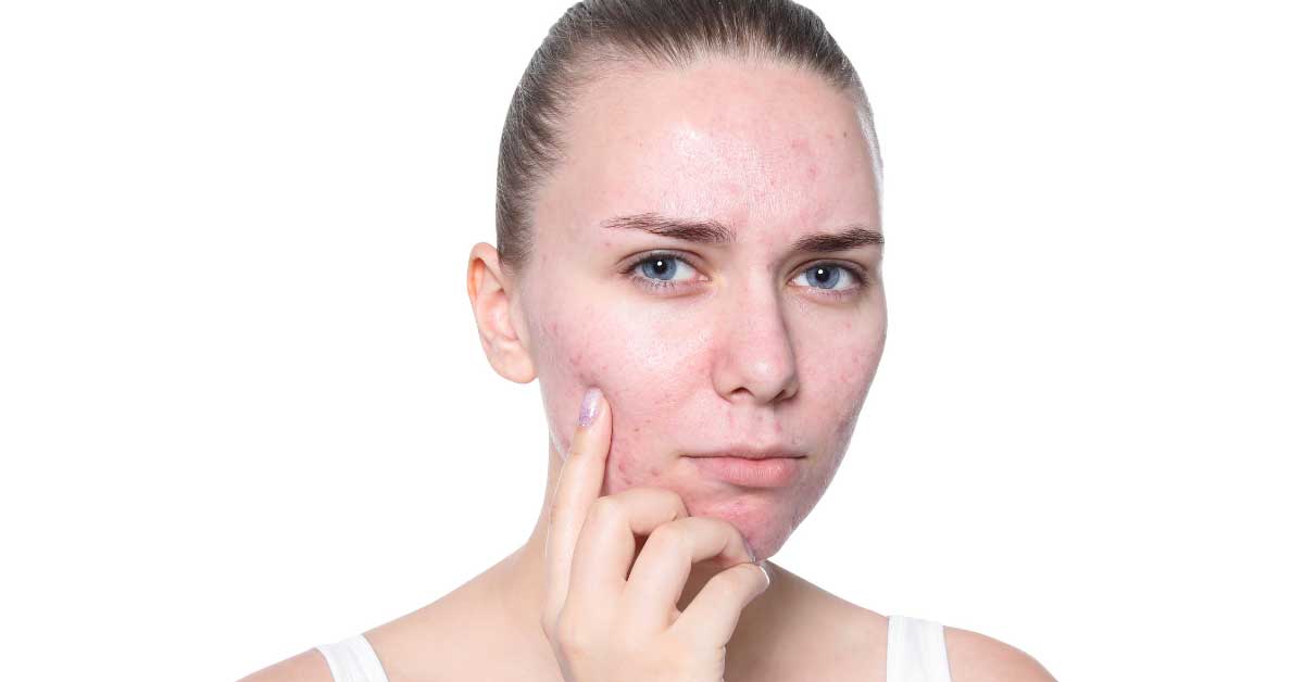  Benzoil peroksid PRAVA STVAR za vaše akne ili NE?