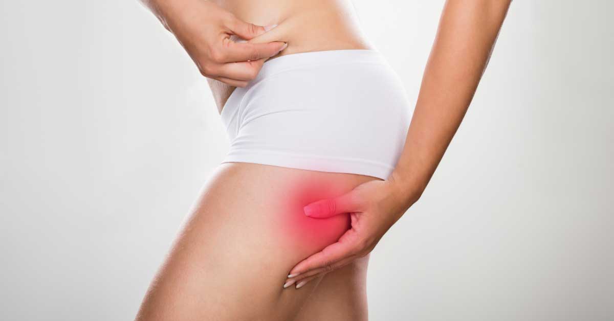  Istina je! Postoji bolan celulit!