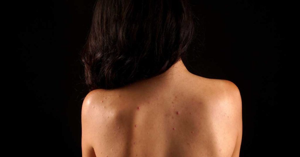 bubuljice na leđima