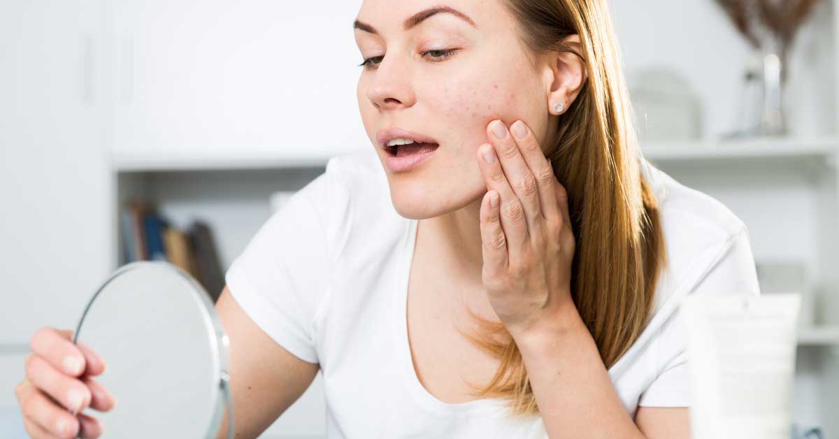  Bubuljice na licu i obrazima: od uzroka do rešenja