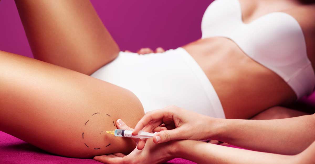 injekcije za celulit