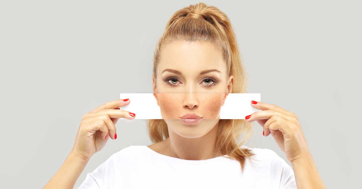  Melazma i kako da je se rešite