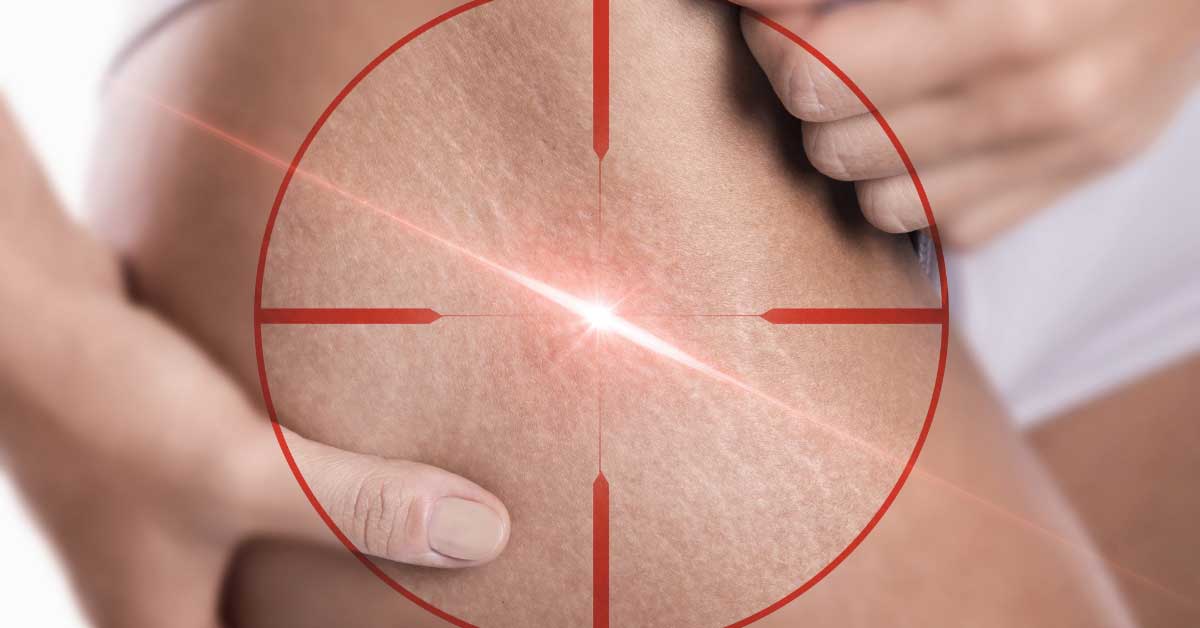  Da li je lasersko uklanjanje strija za vas?