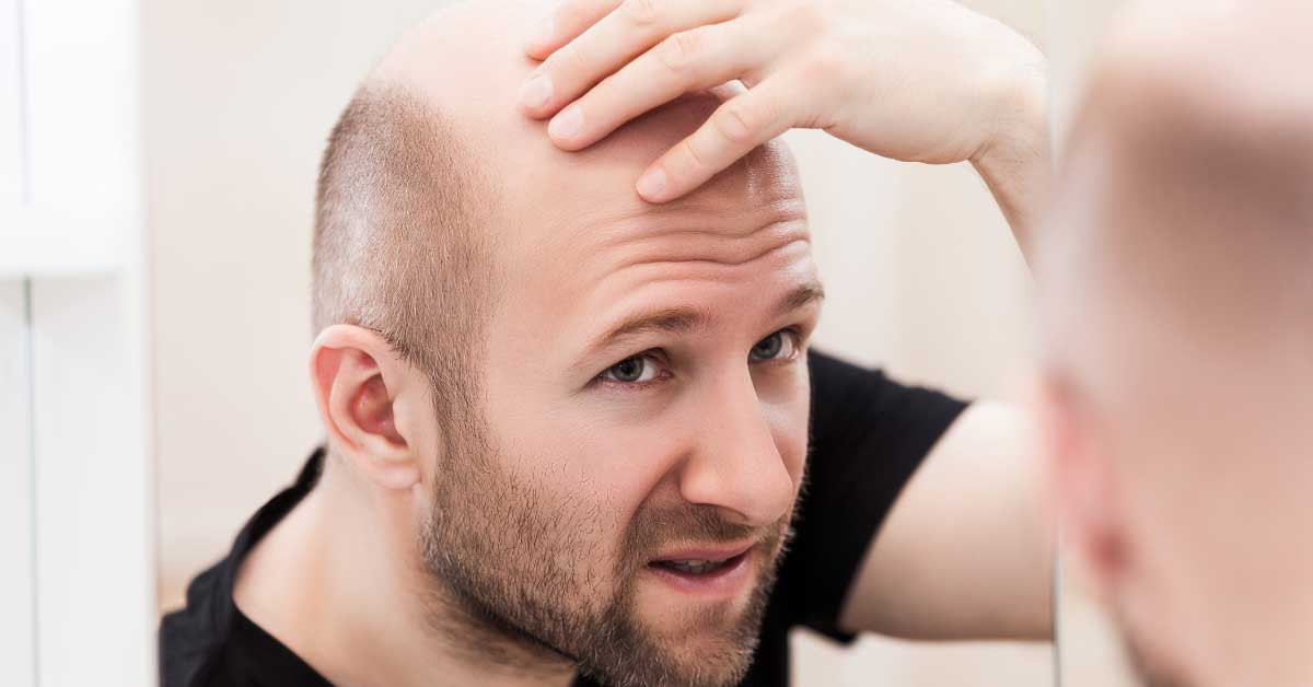  Otkrijte kako pobediti ćelavost kod muškaraca!