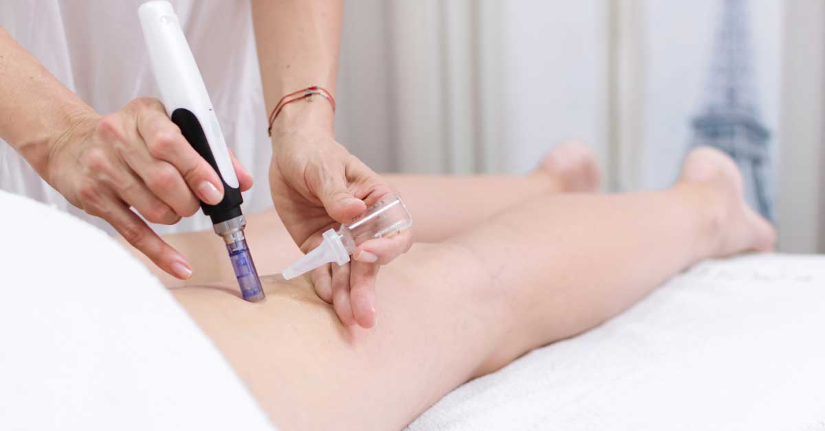  Mezoterapija celulita: šta je, kako se radi i rezultati