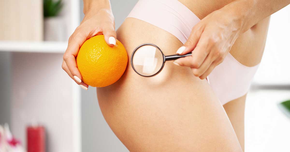  Rešenje PROTIV CELULITA u koje se KUNU i najveći skeptici!