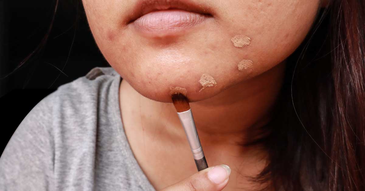  Kako prekriti bubuljice bez instagram filtera?