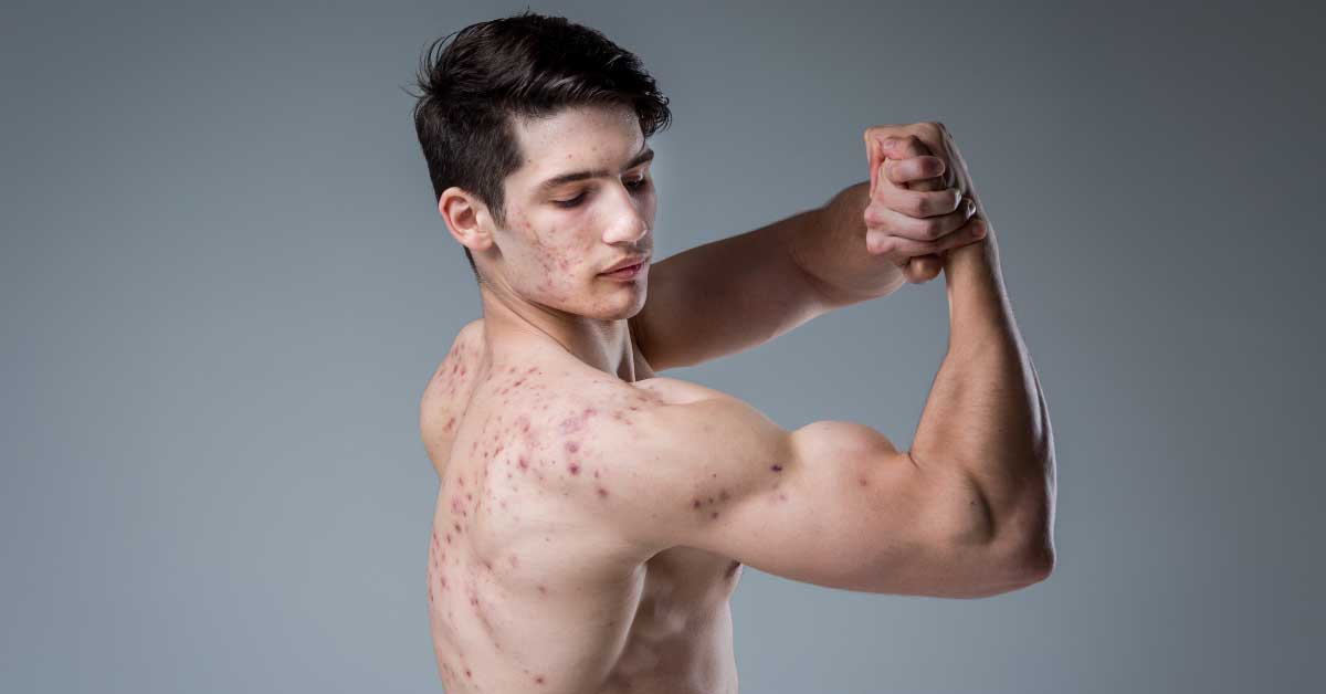  Steroidne akne – problem bodibildera ili ne?
