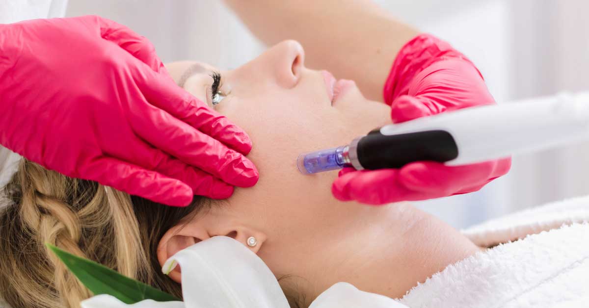  Microneedling tretman za kožu. Zvuči jezivo, ali deluje!