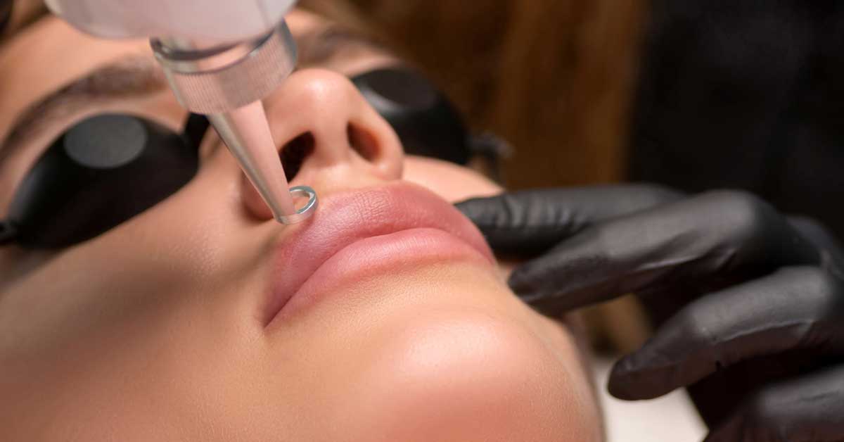  Lasersko povećanje usana: do punoće bez igle