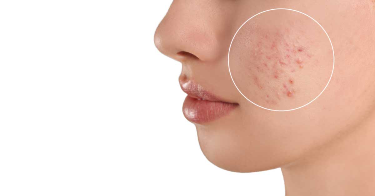 crvenilo od bubuljica