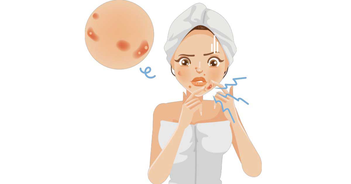  Kompletan vodič kroz vrste akni