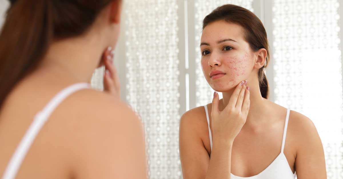  Suva koža sklona bubuljicama? Ima rešenja!