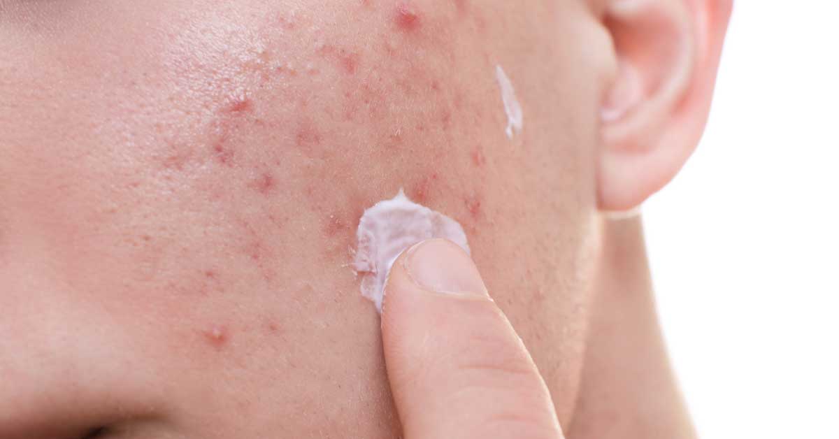 flogocid za bubuljice