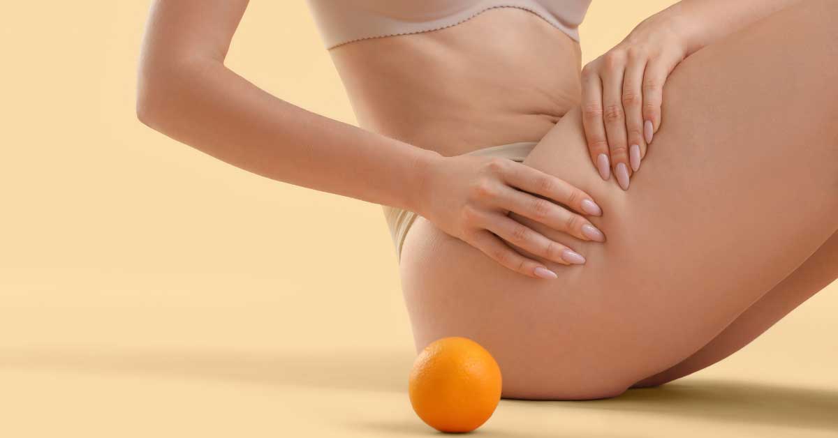  Šta je celulit zapravo? Otkrijte!