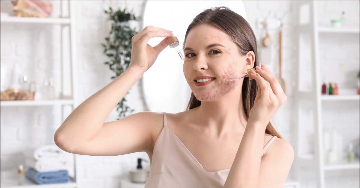  Znate li koji je najbolji serum za akne? Evo liste!